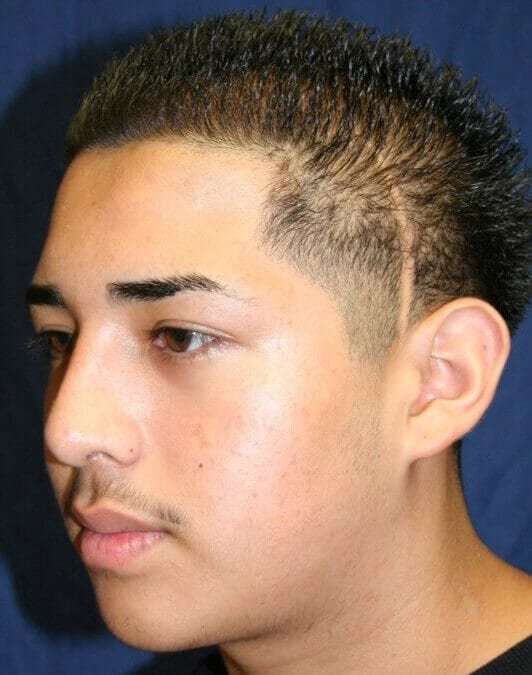 Rhinoplasty Before & After Patient #6068