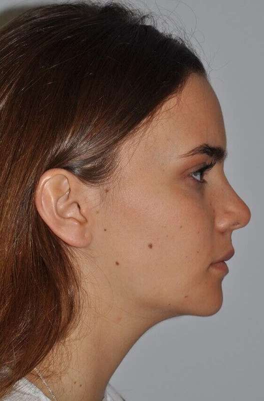 Rhinoplasty Before & After Patient #6075