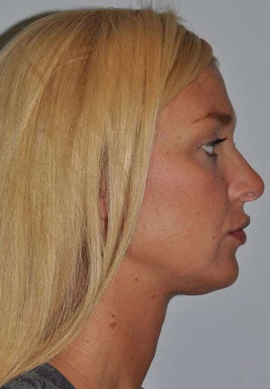 Rhinoplasty Before & After Patient #6087
