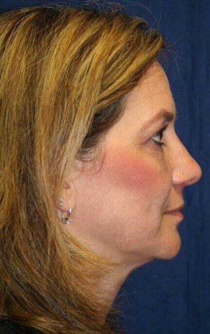 Rhinoplasty Before & After Patient #6099