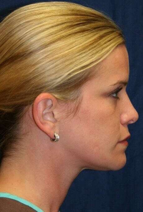 Rhinoplasty Before & After Patient #6106