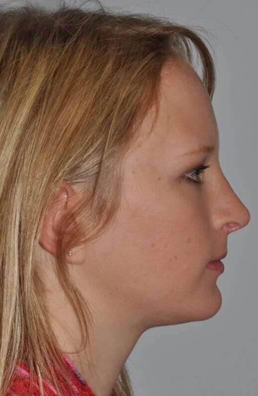 Rhinoplasty Before & After Patient #6113