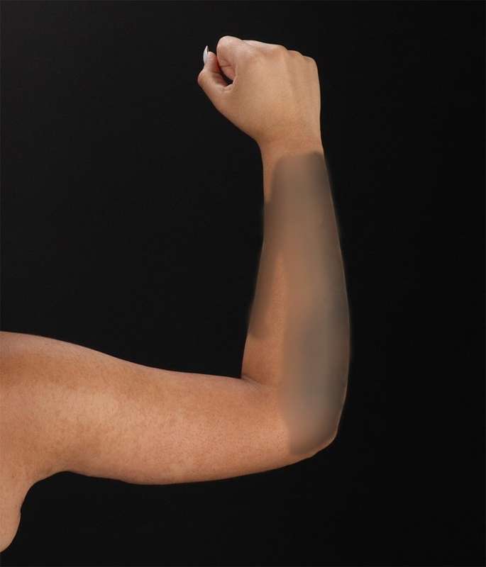 Brachioplasty (Arm Lift) Before & After Patient #1150