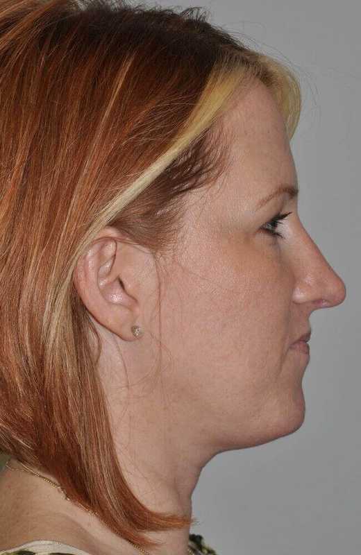 Rhinoplasty Before & After Patient #6120