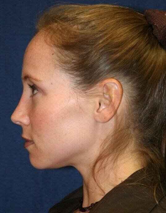 Rhinoplasty Before & After Patient #6132