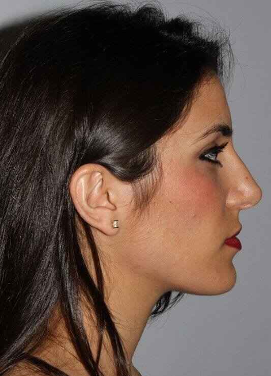 Rhinoplasty Before & After Patient #6139