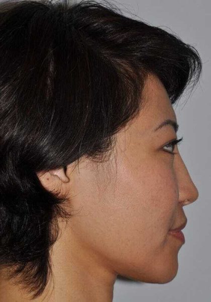 Rhinoplasty Before & After Patient #6146