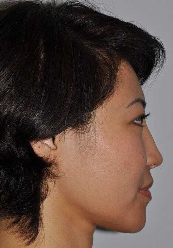 Rhinoplasty Before & After Patient #6146