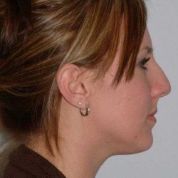 Rhinoplasty Before & After Patient #6153
