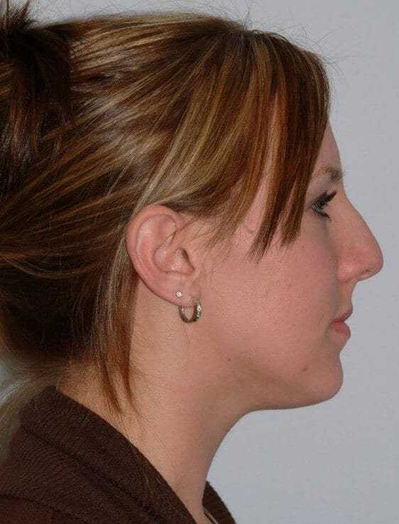 Rhinoplasty Before & After Patient #6153