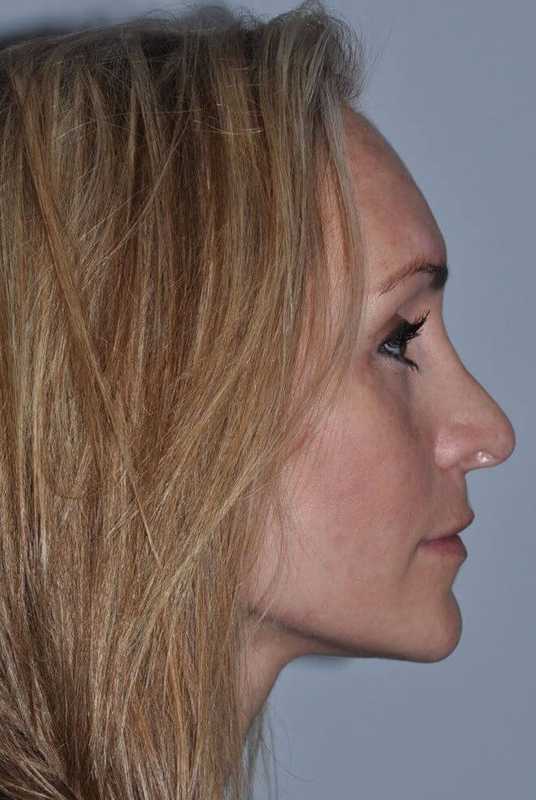 Rhinoplasty Before & After Patient #6160