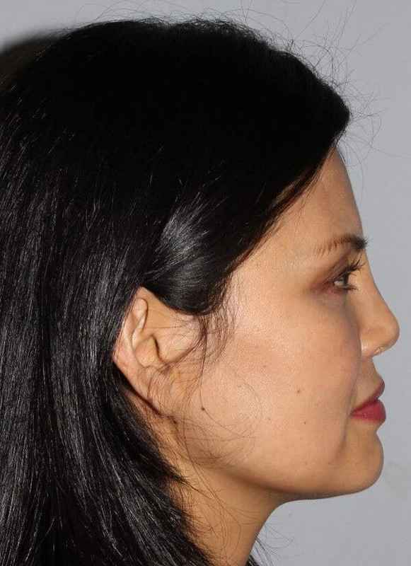 Rhinoplasty Before & After Patient #6167