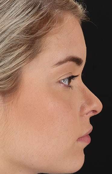 Rhinoplasty Before & After Patient #6178