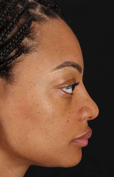 Rhinoplasty Before & After Patient #6189