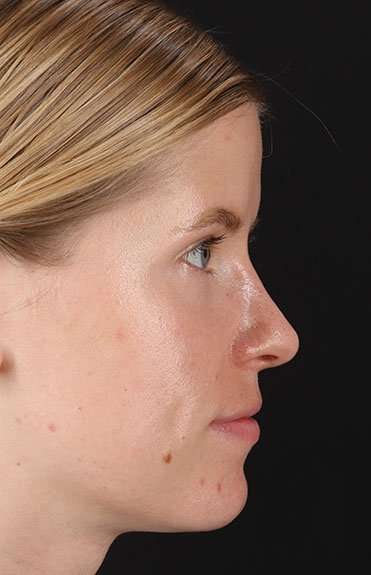 Rhinoplasty Before & After Patient #6200