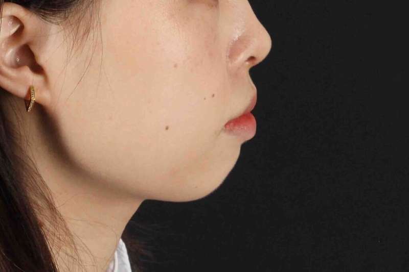 Lip Reduction Before & After Patient #6222