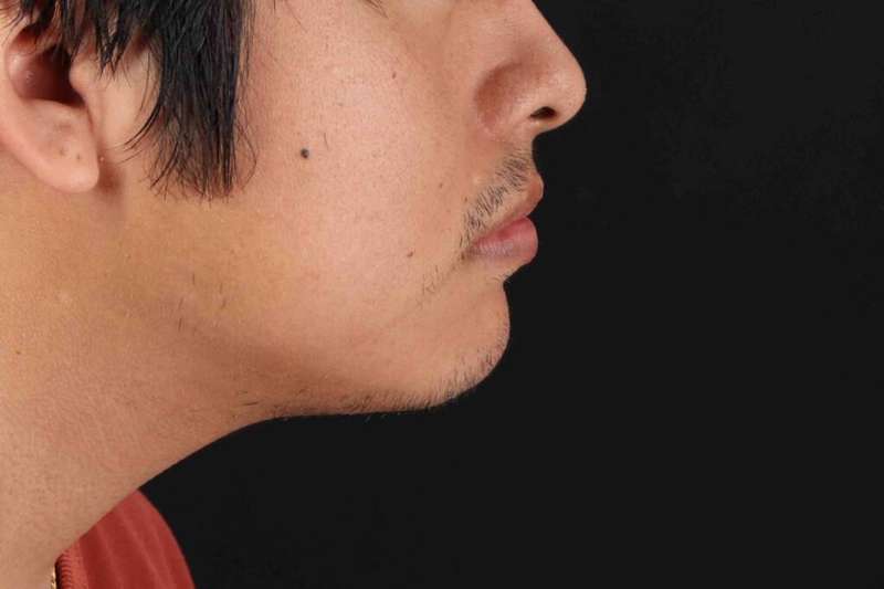 Lip Reduction Before & After Patient #6233