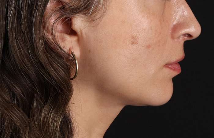 Lip Lift Before & After Patient #6244