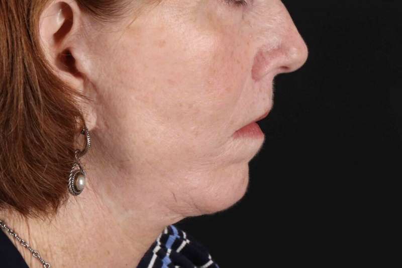 Lip Lift Before & After Patient #6255