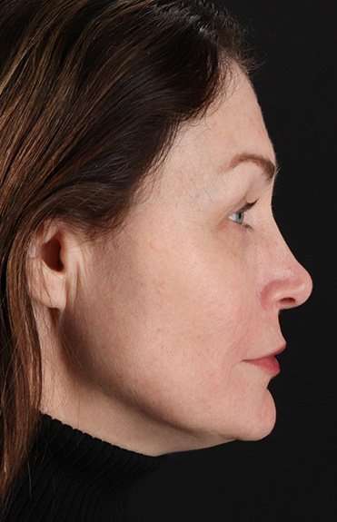 Lip Lift Before & After Patient #6266