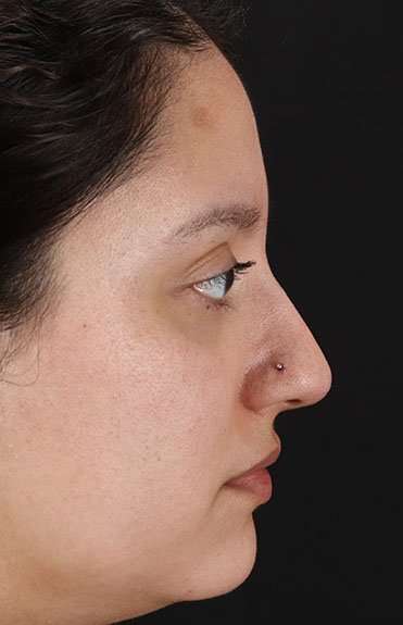 Liquid Rhinoplasty Before & After Patient #6299
