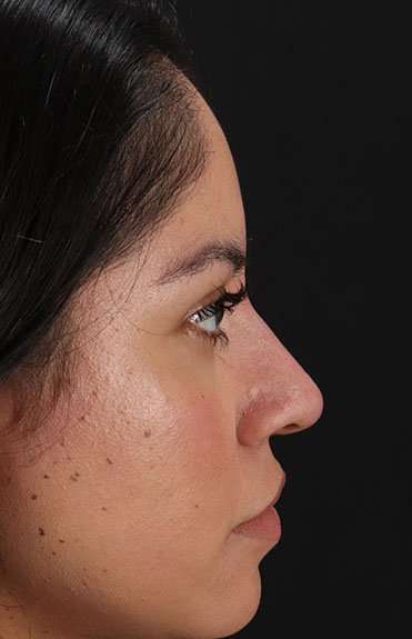 Liquid Rhinoplasty Before & After Patient #6319