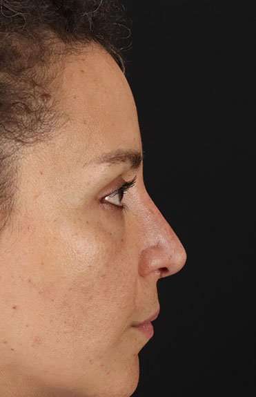 Liquid Rhinoplasty Before & After Patient #6333