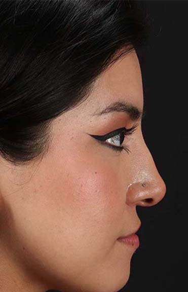 Liquid Rhinoplasty Before & After Patient #6344