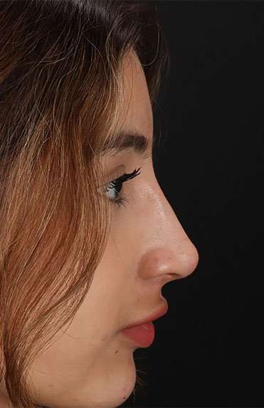 Liquid Rhinoplasty Before & After Patient #6355