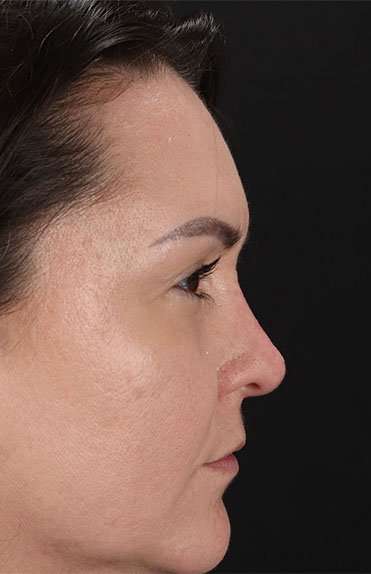 Liquid Rhinoplasty Before & After Patient #6366