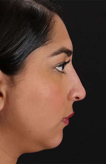 Liquid Rhinoplasty Before & After Patient #6377
