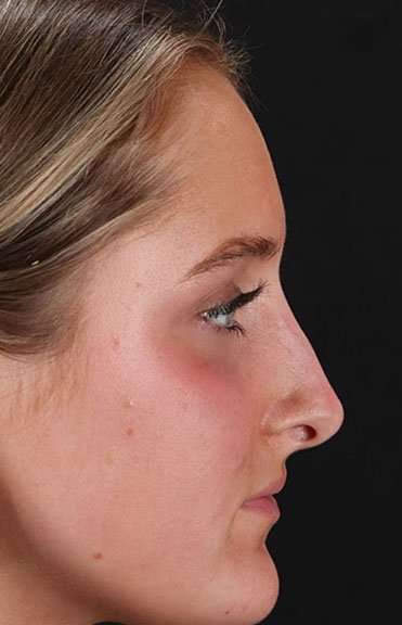 Liquid Rhinoplasty Before & After Patient #6388