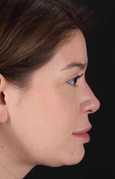Liquid Rhinoplasty Before & After Patient #6399