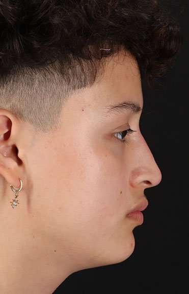 Liquid Rhinoplasty Before & After Patient #6410