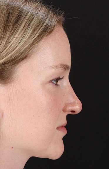 Liquid Rhinoplasty Before & After Patient #6425