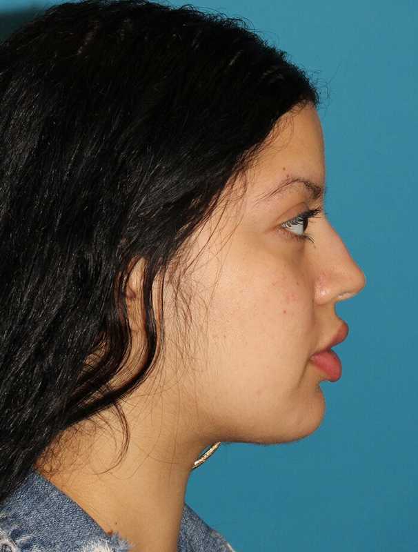 Buccal Fat Pad Before & After Patient #6436