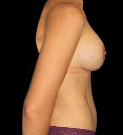 Abdominoplasty (Tummy Tuck) Before & After Patient #613