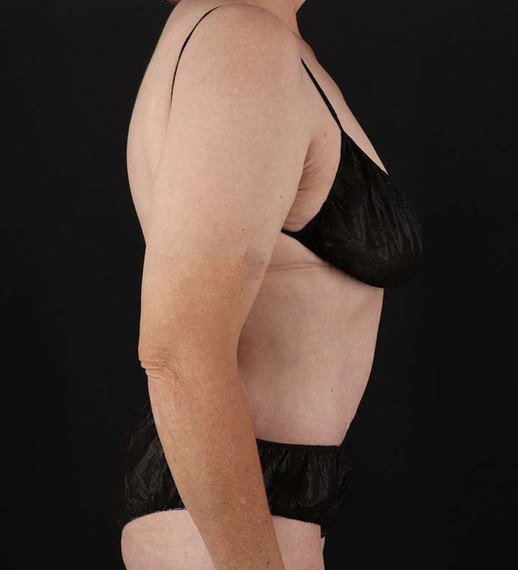 Cosmetic Body Lift Before & After Patient #1218