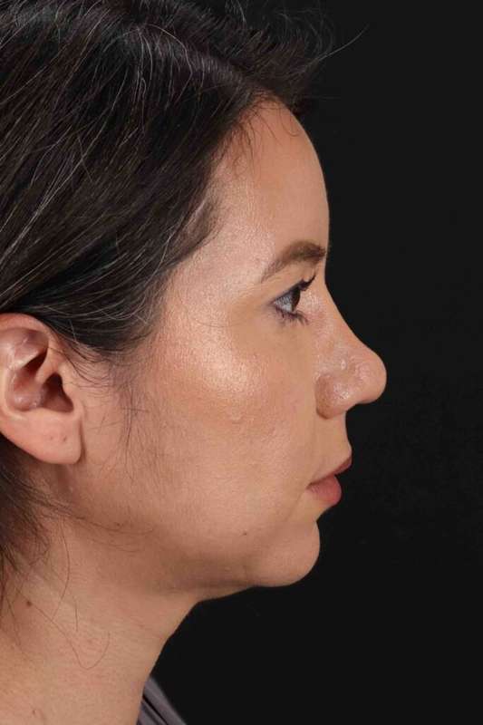 Buccal Fat Pad Before & After Patient #6463
