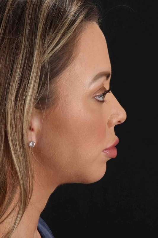 Buccal Fat Pad Before & After Patient #6474