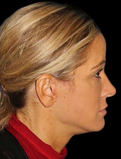 Neck Lift Before & After Patient #6517