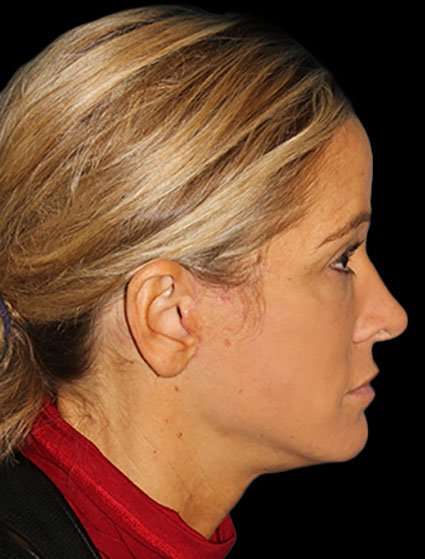 Neck Lift Before & After Patient #6517