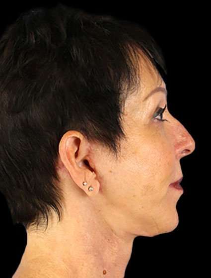 Neck Lift Before & After Patient #6528
