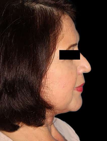 Neck Lift Before & After Patient #6539