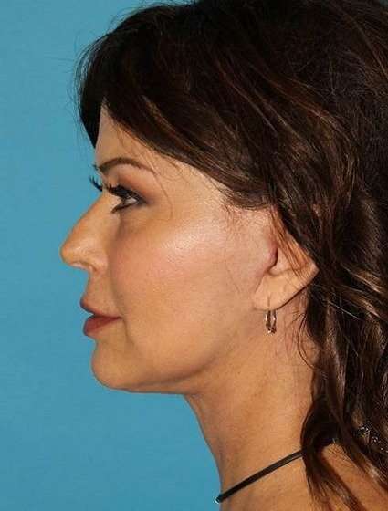 Neck Lift Before & After Patient #6546