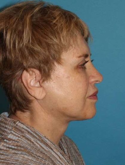 Neck Lift Before & After Patient #6565