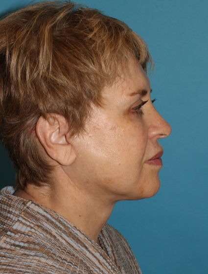 Neck Lift Before & After Patient #6565