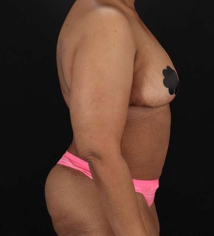 Cosmetic Body Lift Before & After Patient #1234