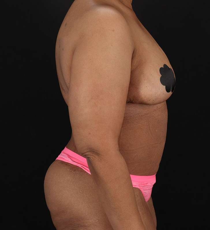Cosmetic Body Lift Before & After Patient #1234