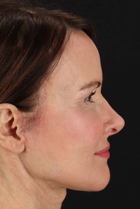 Neck Lift Before & After Patient #6631